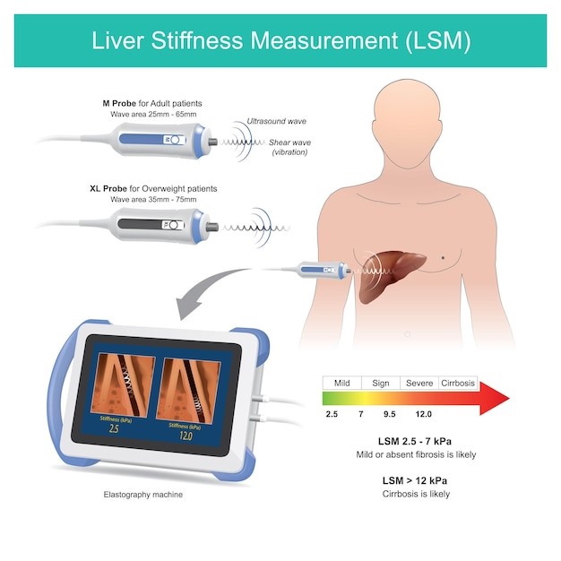 Best Fibroscan liver stiffness measurement in bangalore