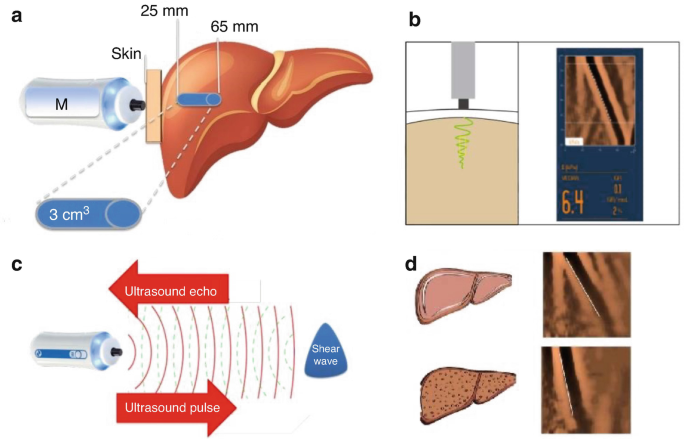 Non-Invasive Liver Fibrosis Test Bangalore