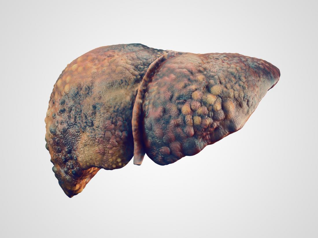 Non-Invasive Liver Fibrosis Test for fatty liver in Bangalore